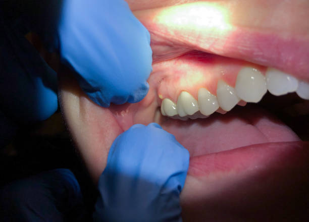 Best Emergency Tooth Extraction in Wallington, NJ